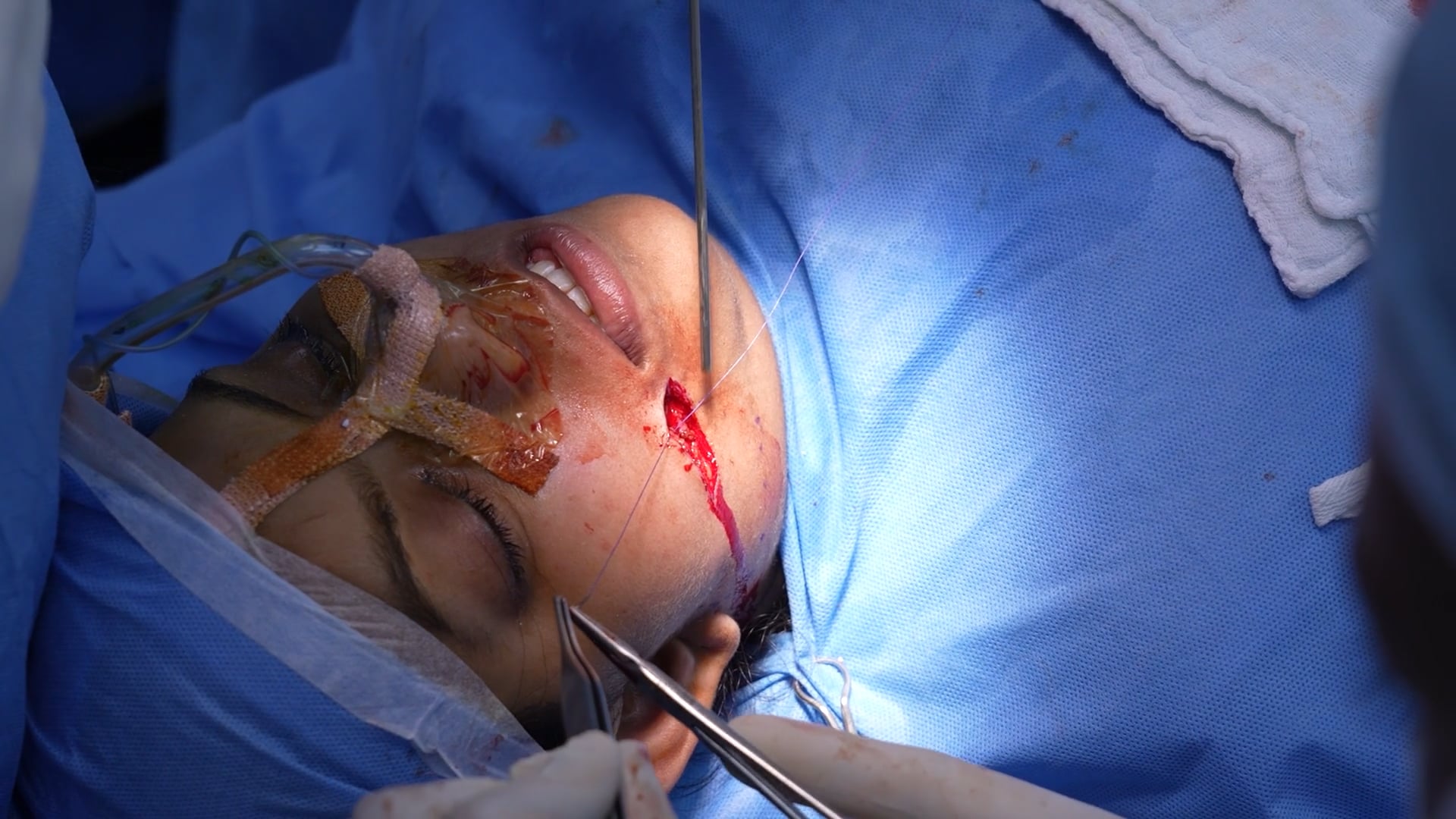 Hemifacial Microsomia Surgery Correction Tessier cleft